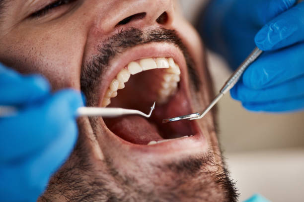 Best Emergency Wisdom Tooth Extraction in Ller, WA